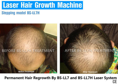 Niedrige Laser-Therapie für Haar-Wachstum